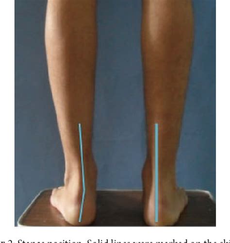 [PDF] Hindfoot Valgus following Interlocking Nail Treatment for Tibial ...