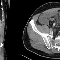 Abdominal CT scan reveals a mechanical occlusion in the right iliac fossa. | Download Scientific ...