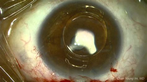 Cataract surgery in phakic IOL eye Part 1: ARTIFLEX - YouTube