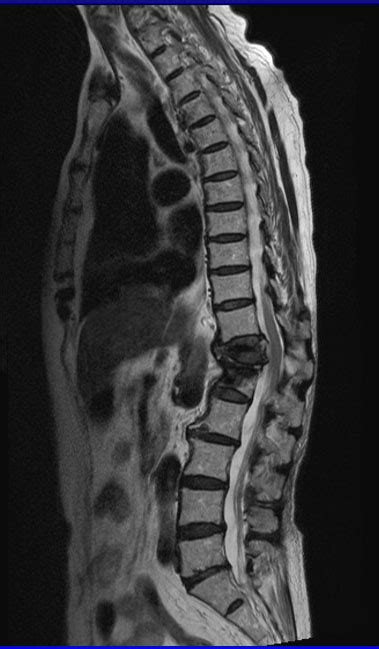 Normal Thoracic Spine Mri