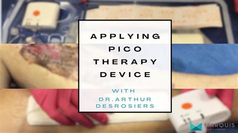 @DrArthurMiami applying the PICO negative pressure wound therapy device - YouTube