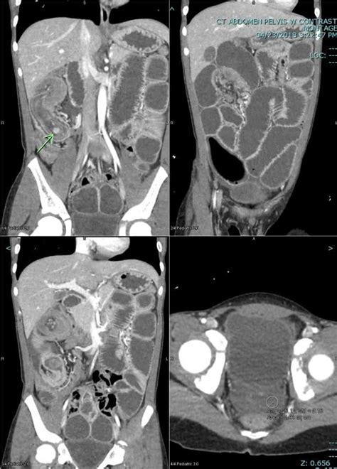 Intussusception | UAMS Department of Radiology