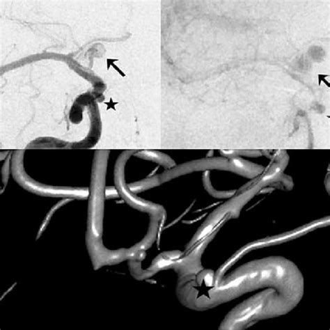 (Case 3) DSA showing two aneurysms on right ICA. Aneurysm of ophthalmic ...