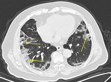 COVID-19 lung patterns show few clues for treating pneumonia - The San ...