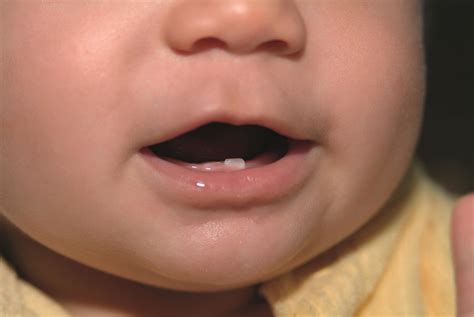 Tooth eruption and teething in children - The Pharmaceutical Journal