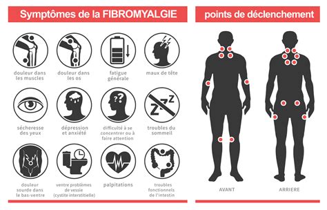 Fibromyalgie : Causes, Symptômes et Traitements - Information hospitalière : Lexique et ...