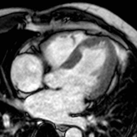 Myocardial contusion | Image | Radiopaedia.org