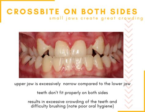 Kids and Crossbites | Hometown Orthodontics