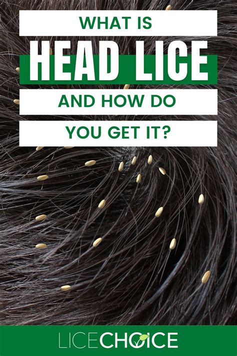 Lice vs. Dandruff - What are the differences between lice, lice eggs ...