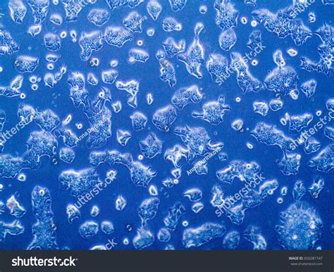 Breast Cancer Tumor Cells Under Microscope Stock Photo 650281747 | Shutterstock