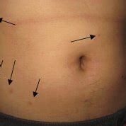 Bite marks (arrows) caused by cat fleas in one of the infested students. | Download Scientific ...