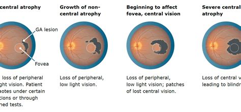 Pegcetacoplan treatment shows increased effects over time in geographic atrophy – Biopharmanalyses