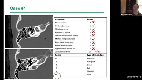 CSF otorrhea - Dr. Kristan Alfonso