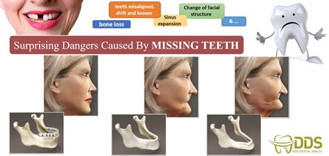 CONSEQUENCES OF MISSING TEETH - DocDentalSmile