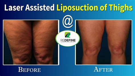 Laser Assisted Thigh Liposuction @Redefine | Latest Technology In ...