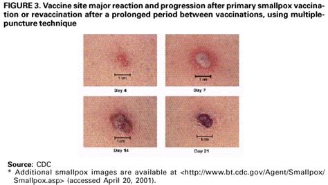 impetigo early stages - pictures, photos