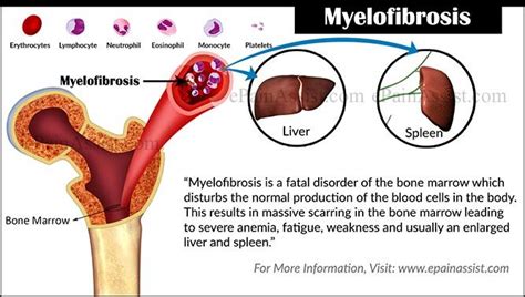 Low HB/WCC/Plt Bone Marrow, Blood Cells, Severe, Disturbing, Disorders, Disease, Low