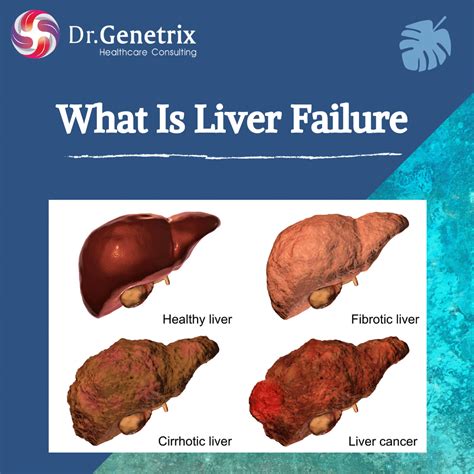 What Is Liver Failure? - Dr.Genetrix