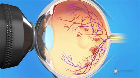 Combined Injection and Laser Treatment for Macular Edema - Oasis Medical Aesthetics