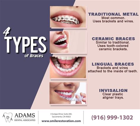 self ligating braces vs traditional braces - shuptrinedebra