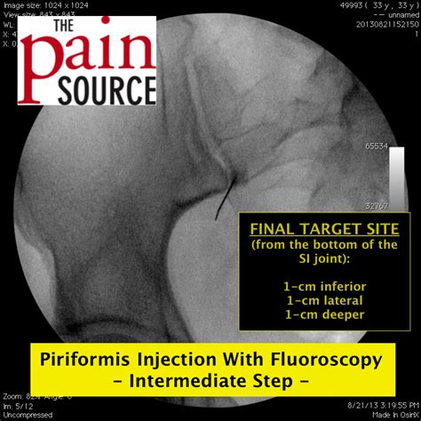 Piriformis Muscle Injection With Fluoroscopy - The Pain Source - Makes ...