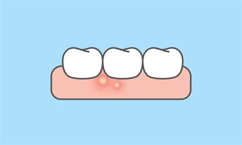 Can You Get A Pimple On Your Gums? Gum Boils Causes