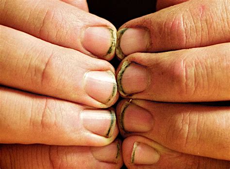 How Your Fingernails Change as You Age