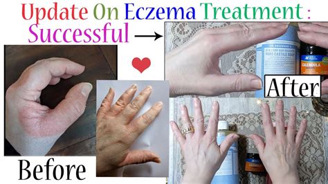 Eczema Fingertips Treatment