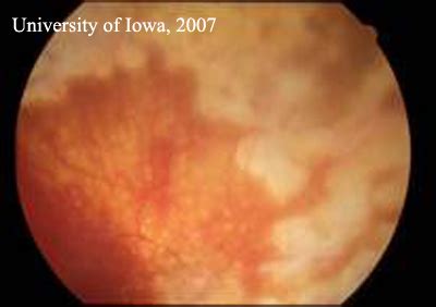 EyeRounds.org:Changing Trends in Sympathetic Ophthalmia: Sympathetic ...