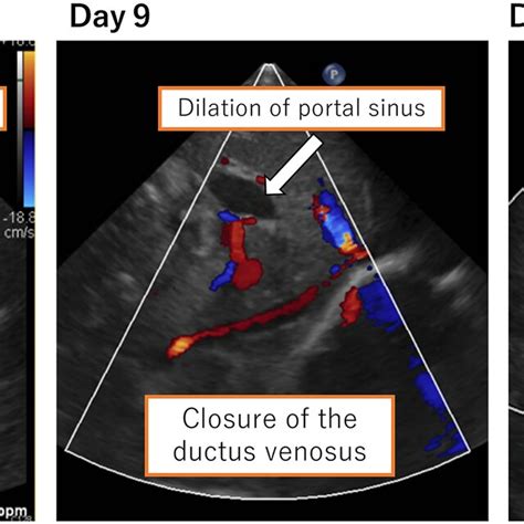 Ductus venosus and dilation of the portal sinus. Closure of the ductus ...