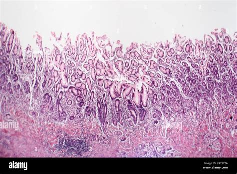 Histopathology of chronic atrophic gastritis, light micrograph, photo ...