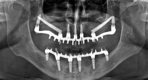 Zygomatic Dental Implants Procedure Explained - NY Implant Clinic