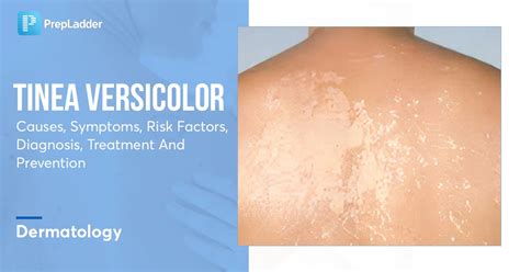 Tinea Versicolor: Causes, Symptoms, Risk Factors, Diagnosis, Treatment ...