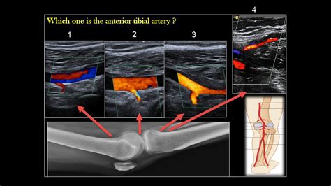 Peroneal Artery Ultrasound