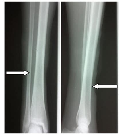 (A) Chronic venous leg ulcer and (B) an example of a commercially... | Download Scientific Diagram