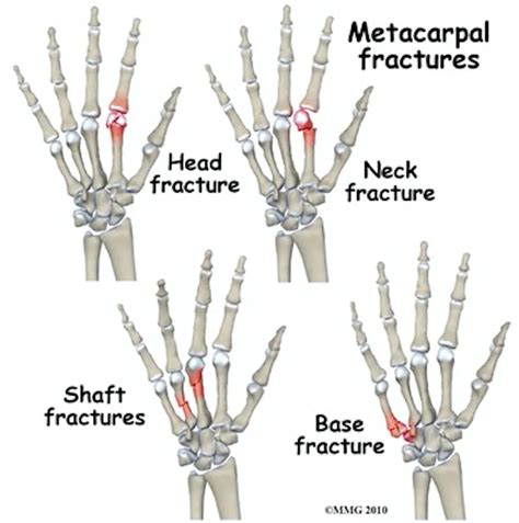 Orthopedics — Blog — Maimonides Emergency Medicine Residency