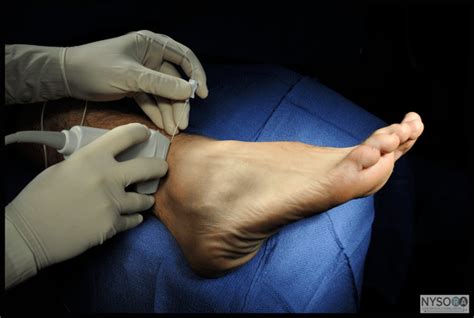 Ultrasound Guided Ankle Block - NYSORA The New York School of Regional Anesthesia