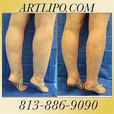 #Cankles, #Ankles, #Calves, and #Knees are areas that many women aren't aware that #Liposuction ...