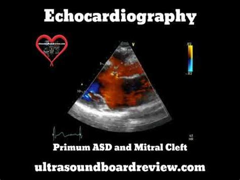 Cleft Mitral Valve - YouTube