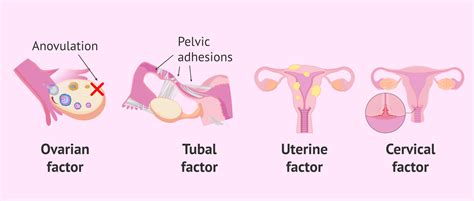 Infertility Causes Women