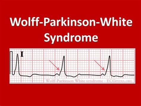 Wolff-Parkinson White Syndrom: ECG Findings | ECG WPW Syndrome - YouTube