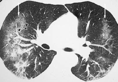 Crack lung: The acute syndrome hits headlines again