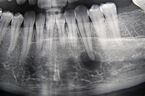 Periapical Cemental Dysplasia in a 28-year-old female patient - a photo on Flickriver