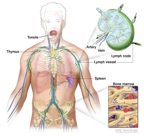 Chronic granulomatous disease: MedlinePlus Genetics