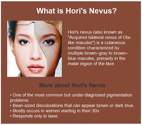 Skin Beauty / Color Spot removal / Hori's Nevus_Plastic Surgery ...