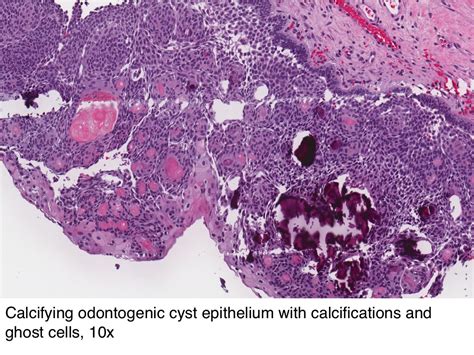 Pathology Outlines - Calcifying odontogenic cyst