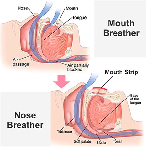 Mouth Breathing Causes and Long-Term Impacts