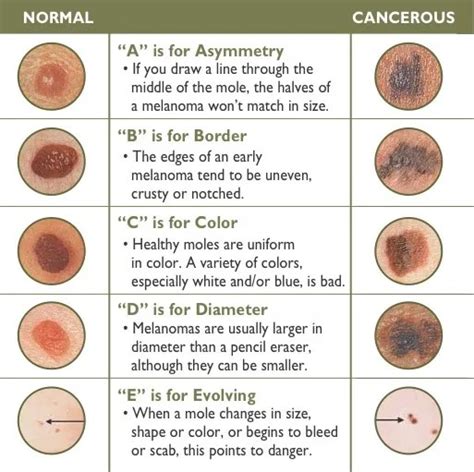 What do Skin Cancers Types Look Like? « CancerWORLD Cancer Treatment ...