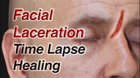 Facial Laceration Time Lapse Healing via Secondary Intention - YouTube