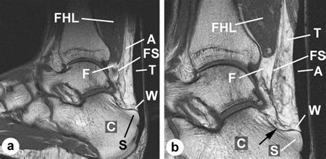 The functional anatomy of Kager's fat pad in relation to retrocalcaneal ...